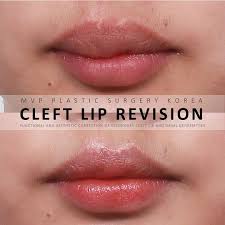 The amount of stitches in the incision line will depend on the extent of the initial deformity and the technique used by the surgeon for closure. Cleft Surgery Korea Home Facebook