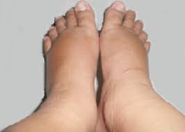 Meskipun bagian paling bawah dari tubuh adalah bagian yang paling sering terkena pembengkakan akan tetapi tidak tertutup nah, di atas adalah penyebab kaki bengkak saat hamil dan cara untuk mengatasinya. Apa Penyebab Kaki Bengkak Dan Bagaimana Mengatasinya Menit Info