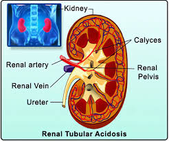 Distal tubule is responsible for generating new bicarbonate under influence of type 3 is a vanishingly rare combination of types 1 and 2. Renal Tubular Acidosis Rta Causes Types Diagnosis Treatment Complications