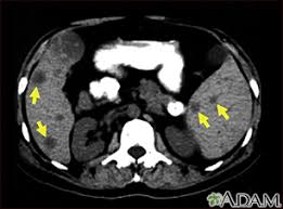 Breast cancer is a leading cause of cancer death worldwide. Abdominal Ct Scan Information Mount Sinai New York