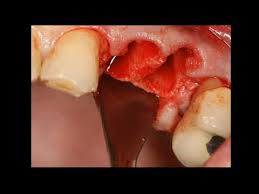 If you are asking about how long the healing takes then there are two answers. Extraction Flap Bone Graft Membrane Placement Suturing Youtube