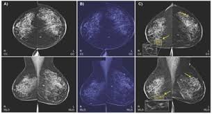 Breast cancer incidence over time. Ai Models Predict Breast Cancer With Radiologist Level Accuracy