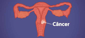 Also get information on testing for hpv and on the hpv vaccines. Gejala Kanser Serviks Kehidupan Intim Semua Tentang Kesihatan Anda
