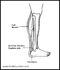 How do you treat sprained achilles heel? Achilles Tendon Rupture Footeducation