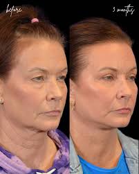 This lovely patient in her late 50's underwent full facial rejuvenation  tailored to her personal goals and signs of facial aging including: