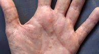 Dyshidrotic Eczema Overview Causes Diagnosis And Pictures Eczema On Hands Eczema Causes Get Rid Of Eczema