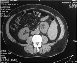 Image result for Nephrolithiasis Imaging
