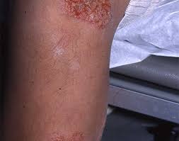 Image result for Eczema nummulare