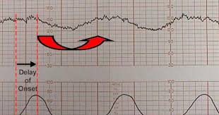Electronic Fetal Monitoring Video The Brookside Associates Fetal Heart Monitoring Nursing Fun Newborn Heart Rate