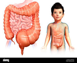 Image result for Megacolon