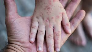 Viruela del mono: síntomas y causas de una infección con patrón nuevo