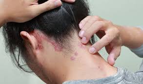 Fish oil, vitamin d, milk thistle, aloe vera, oregon grape, and evening primrose oil have all been reported to help ease mild. Dr Batra S Homeopathic Treatment Uae Homeopathic Remedies Online