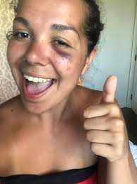 Accident with sea urchin in Hawaii