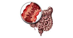 Chrohns Disease Symptoms Causes Diagnosis And Treatment