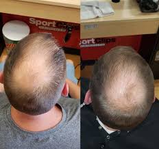 Some individuals after being on the system for a period of time begin seeing daily hair loss numbers increase and are concerned that the bionutrient formulations system is causing this hair loss. Nioxin Review Side Effects With Before And After Results