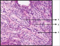 The appearance of these abnormal nuclei to dr. Orphan Annie Eye Nuclei Bavle Rm J Oral Maxillofac Pathol