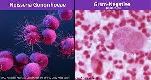 Image result for gonorrhea symptoms