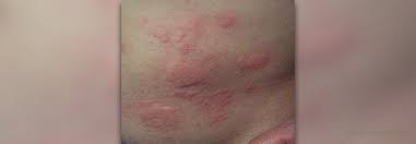 We did not find results for: Facts On Underarm Rash Skin Hair Problems Articles Body Health Conditions Center Steadyhealth Com