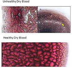 Live And Dry Blood Cell Analysis In Etobicoke Better Living