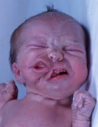 Postgraduate doctors' training institute 1, presidential prenatal center2, cheboksary. Tmj And Mandibular Congenital Malformations Springerlink
