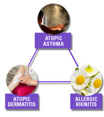 Image result for Allergic Triad