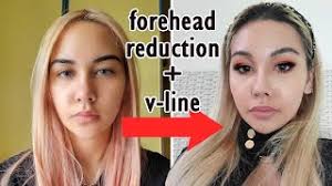 There is a visible scar but is usually too pale to be noticed even after a year. Forehead Reduction Threadlift Vlog Plastic Surgery Youtube