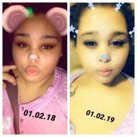 Before and After Duodenal Switch Photos