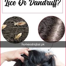 Image result for lice vs dandruff