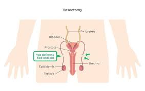 Image result for Vasectomy