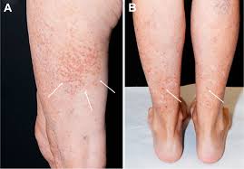 Image result for Vasculitis