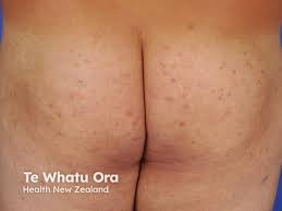 Image result for itchy skin rectum