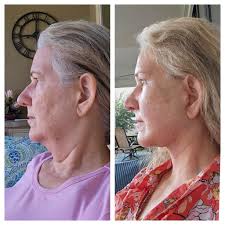 2 months post op concerns about triangular shaped nostrils. Are there  massages I can do to help with this? Does this mean the surgeon didn't do  good work or will this alleviate