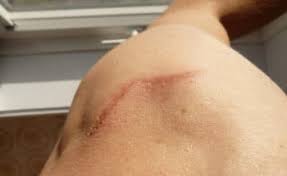 These polyps vary in size, and they can grow singly or in clusters. Scar Revisions Ear Nose And Throat Ltd