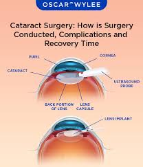 Image result for Cataract Extraction