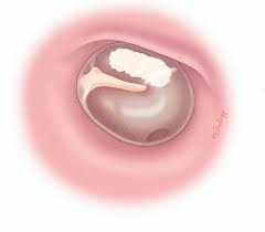 Image result for Myringosclerosis