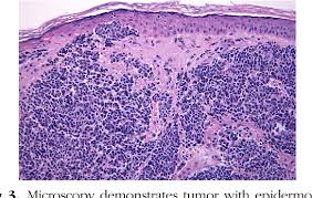 Maybe you would like to learn more about one of these? Epidermotropic Merkel Cell Carcinoma A Case Series With Histopathologic Examination Semantic Scholar