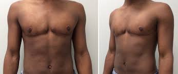 Dr Stanwix Ftm Transgender Top Surgery Ftm (transmasculine) gender affirmation surgery baltimore, maryland. dr stanwix ftm transgender top surgery