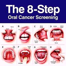 Image result for gum cancer symptoms