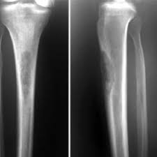 Diagnosed with benign (n = 29) or malignant (n = 18) bone tumors . A Anteroposterior Radiograph Of The Proximal Tibia Shows A Download Scientific Diagram