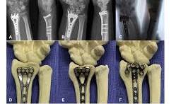 Proper Plate Position on Distal Radius fractures lowers FPL ...