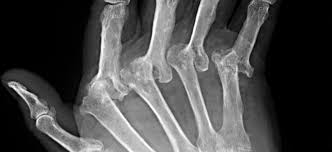 Image result for XRay Changes in Rheumatic Conditions