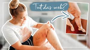 1 5 Wochen Nach Lipodem Op Update Alles Tut Weh Vlog Youtube