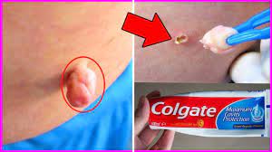 Featured in webmd · 100% money back guarantee · read our reviews now How To Remove Skin Tag In 1 Night Of Applying Toothpaste Home Remedies To Remove Skin Tags Easily Youtube