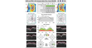 Image result for Acute Vision Loss