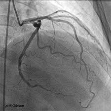 Hypoplastic left coronary artery was found in six specimens. Left Anterior Descending Artery Wikidoc
