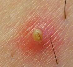 Genital warts, also called condyloma accuminata or venereal warts, are symptoms of a highly contagious sexually transmitted disease caused by certain types of human. Ingrown Hair Does Herpes Look Like Ingrown Hairs