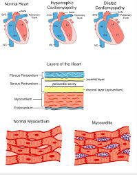Image result for Myocarditis