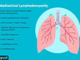Die copd zählt zu den chronischen erkrankungen der atemwege. Mediastinal Lymphadenopathy