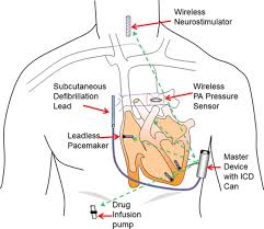 Medical education pacemaker, icd, and crt overview. Future Of Implantable Devices For Cardiac Rhythm Management Circulation