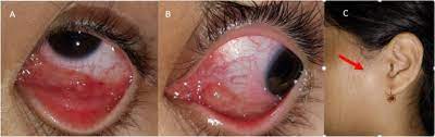 The Clinical Spectrum Of Ocular Bartonellosis A Retrospective Study At A Tertiary Centre In Malaysia Journal Of Ophthalmic Inflammation And Infection Full Text